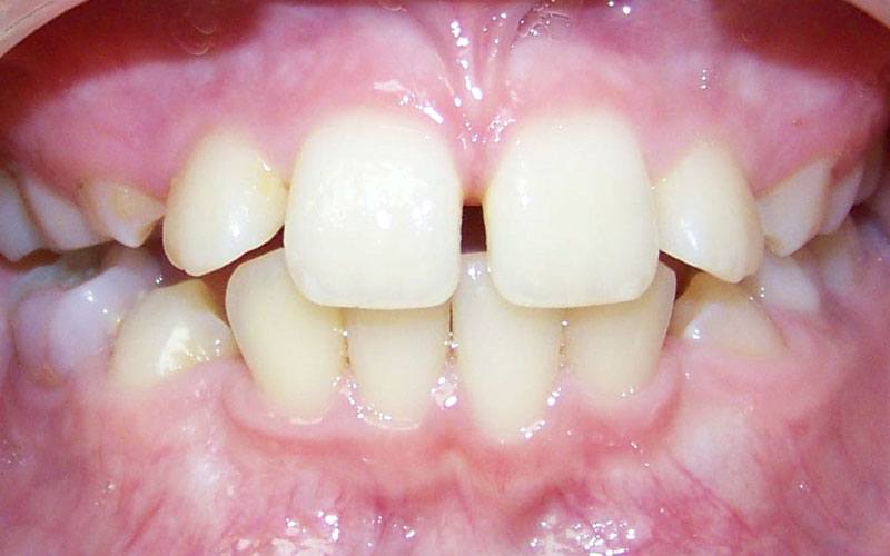 Patient 4 before braces