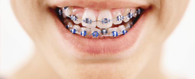 braces smiling