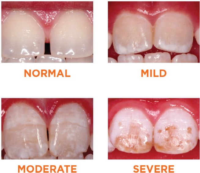 Albums 99+ Images pictures of teeth without enamel Latest