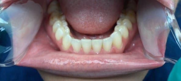 virtual smile example bottom