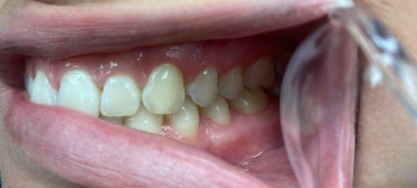 virtual-smile-assessment-right virtual smile example left