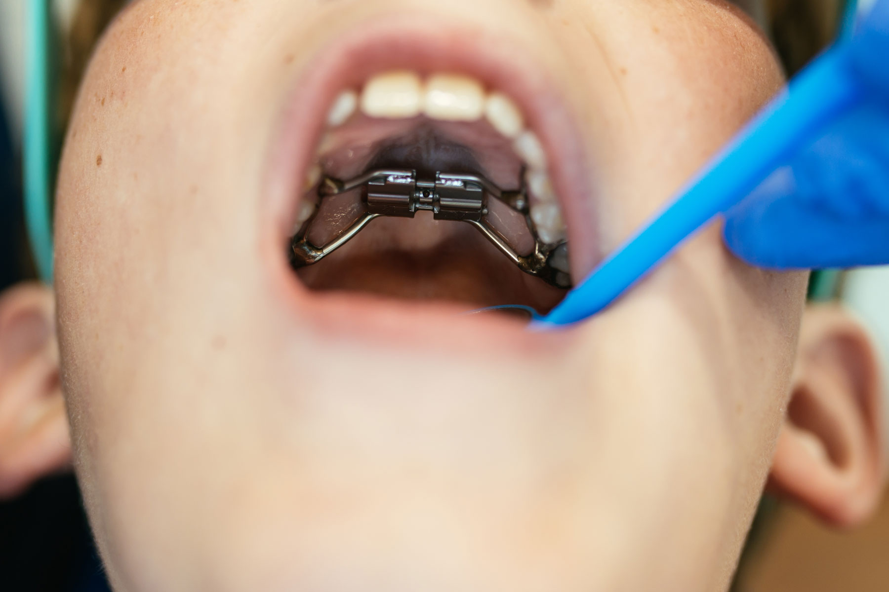 irway Orthodontics in Midlothian -- close-up of a palate expander fitted on a child's upper jaw at Richmond Pediatric Dentistry and Orthodontics