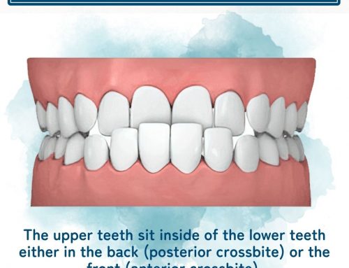 Crossbite Correction in Midlothian, VA