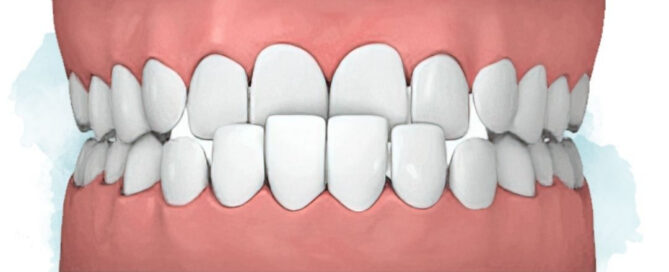 Crossbite correction in Midlothian VA showing upper teeth sitting inside lower teeth — treated by specialty-trained orthodontists at Richmond Pediatric Dentistry and Orthodontics in Midlothian, VA
