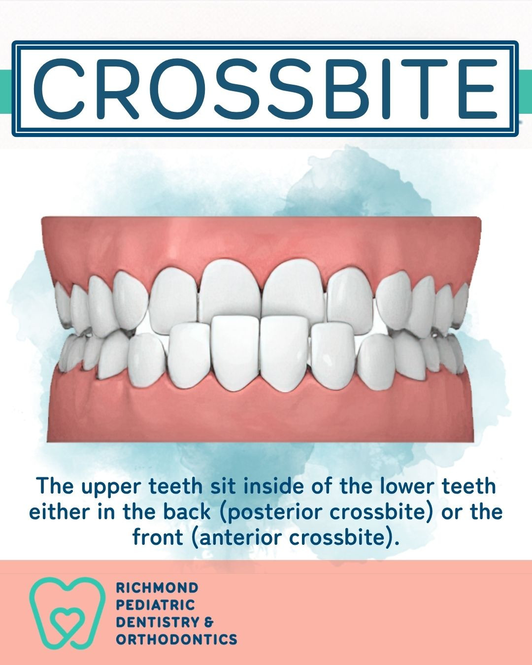 Crossbite correction in Midlothian VA showing upper teeth sitting inside lower teeth — treated by specialty-trained orthodontists at Richmond Pediatric Dentistry and Orthodontics in Midlothian, VA