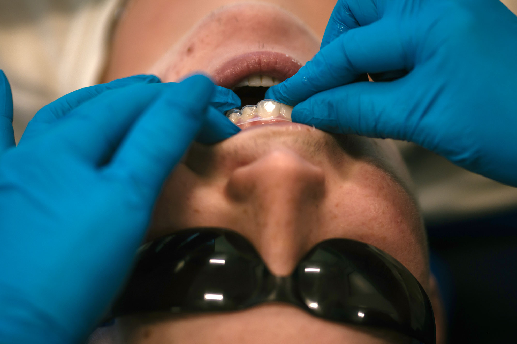 Invisalign in Richmond, VA for Teens & Adults 2 Orthodontist fitting a clear aligner for a patient at Richmond Pediatric Dentistry and Orthodontics