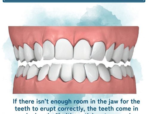 Crooked Teeth Treatment in Richmond, VA
