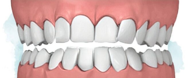 Crooked Teeth Treatment in Richmond, VA 3 Dental crowding illustration showing crooked, overlapping teeth from too little jaw space, Richmond Pediatric Dentistry and Orthodontics