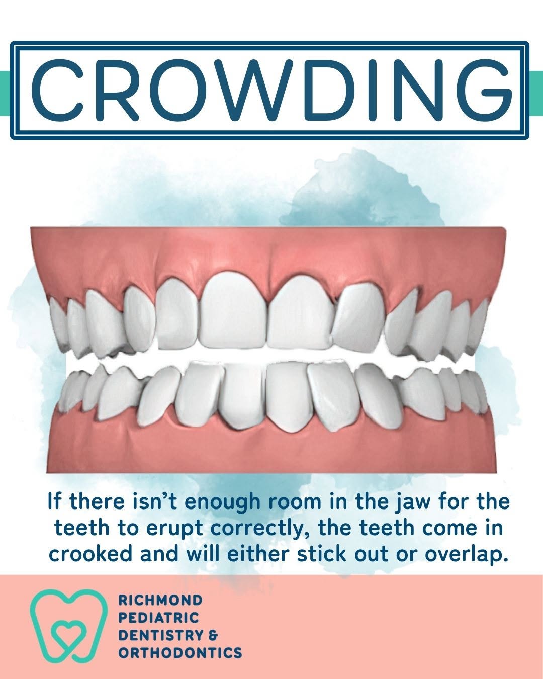 Dental crowding illustration showing crooked, overlapping teeth from too little jaw space, Richmond Pediatric Dentistry and Orthodontics