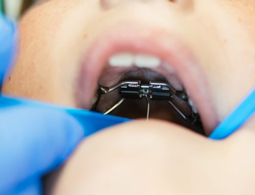 Phase 1 Orthodontic Treatment for Kids in Richmond, VA