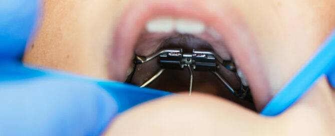 Phase 1 Orthodontic Treatment for Kids in Richmond, VA 2 Close-up of a fixed early orthodontic appliance on a child's upper teeth during Phase 1 treatment in Richmond, VA