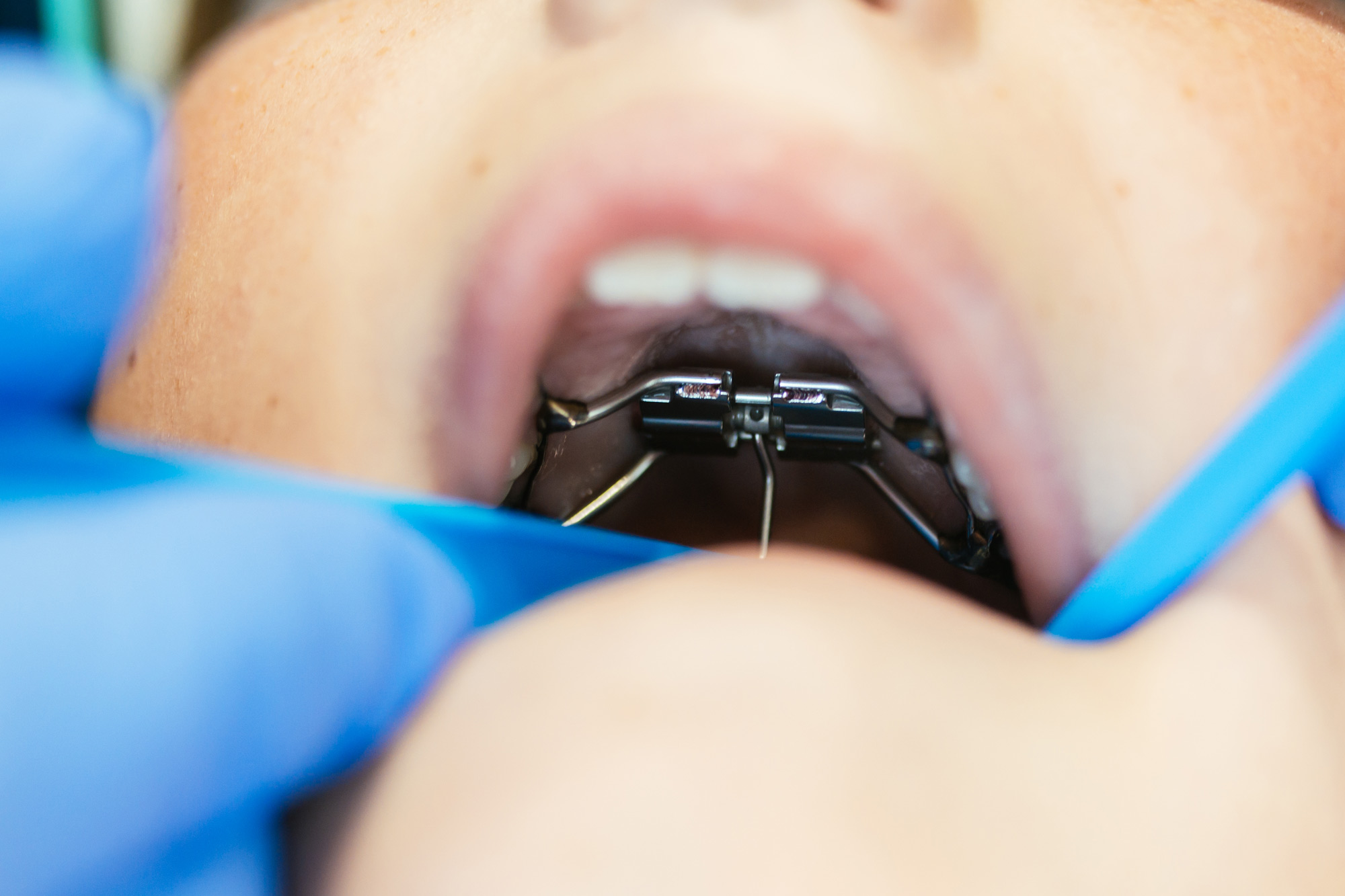 Close-up of a fixed early orthodontic appliance on a child's upper teeth during Phase 1 treatment in Richmond, VA