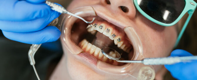 Orthodontist bonding brackets to a patient's upper teeth during a braces placement appointment