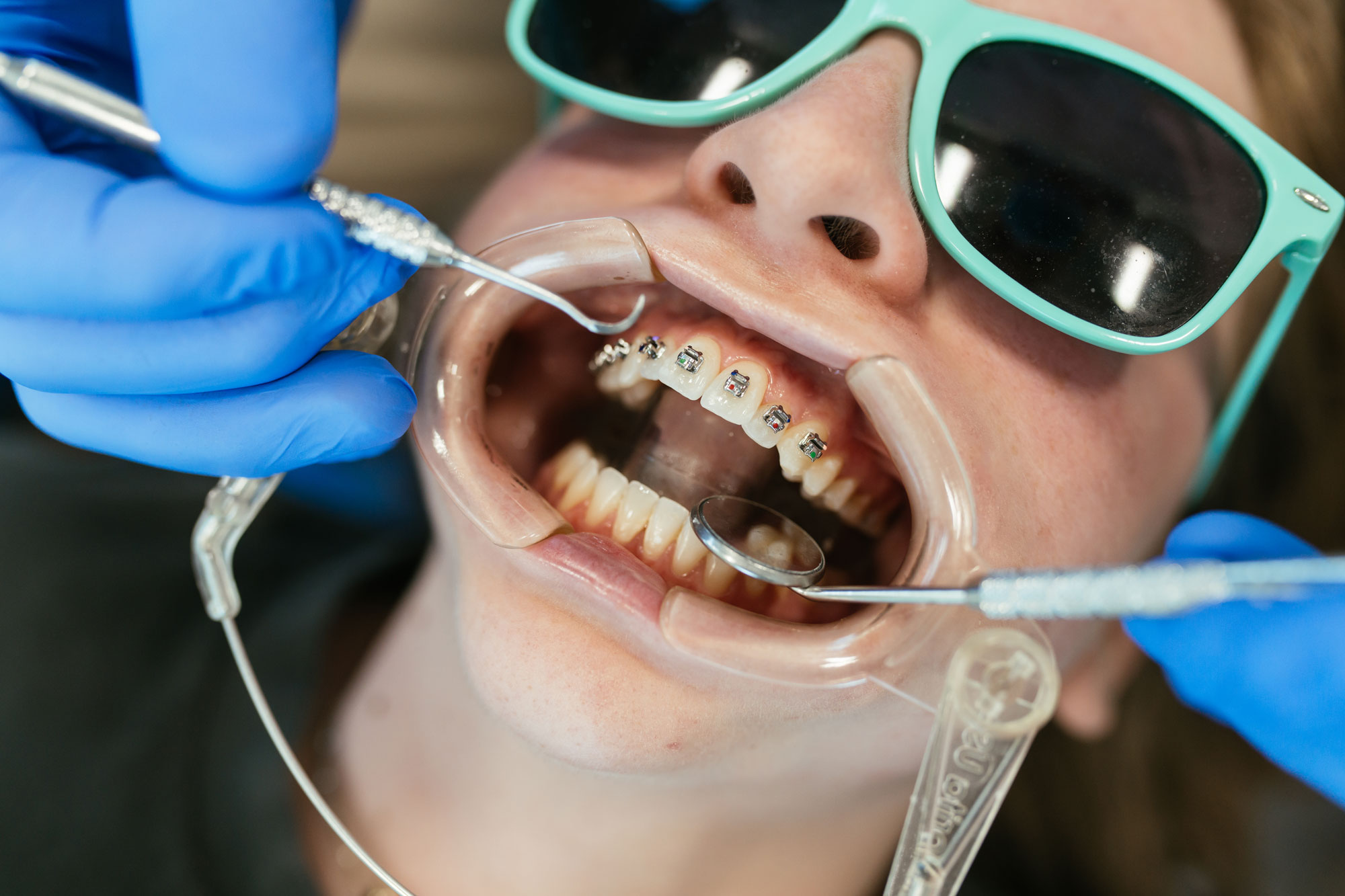 Orthodontist bonding brackets to a patient's upper teeth during a braces placement appointment
