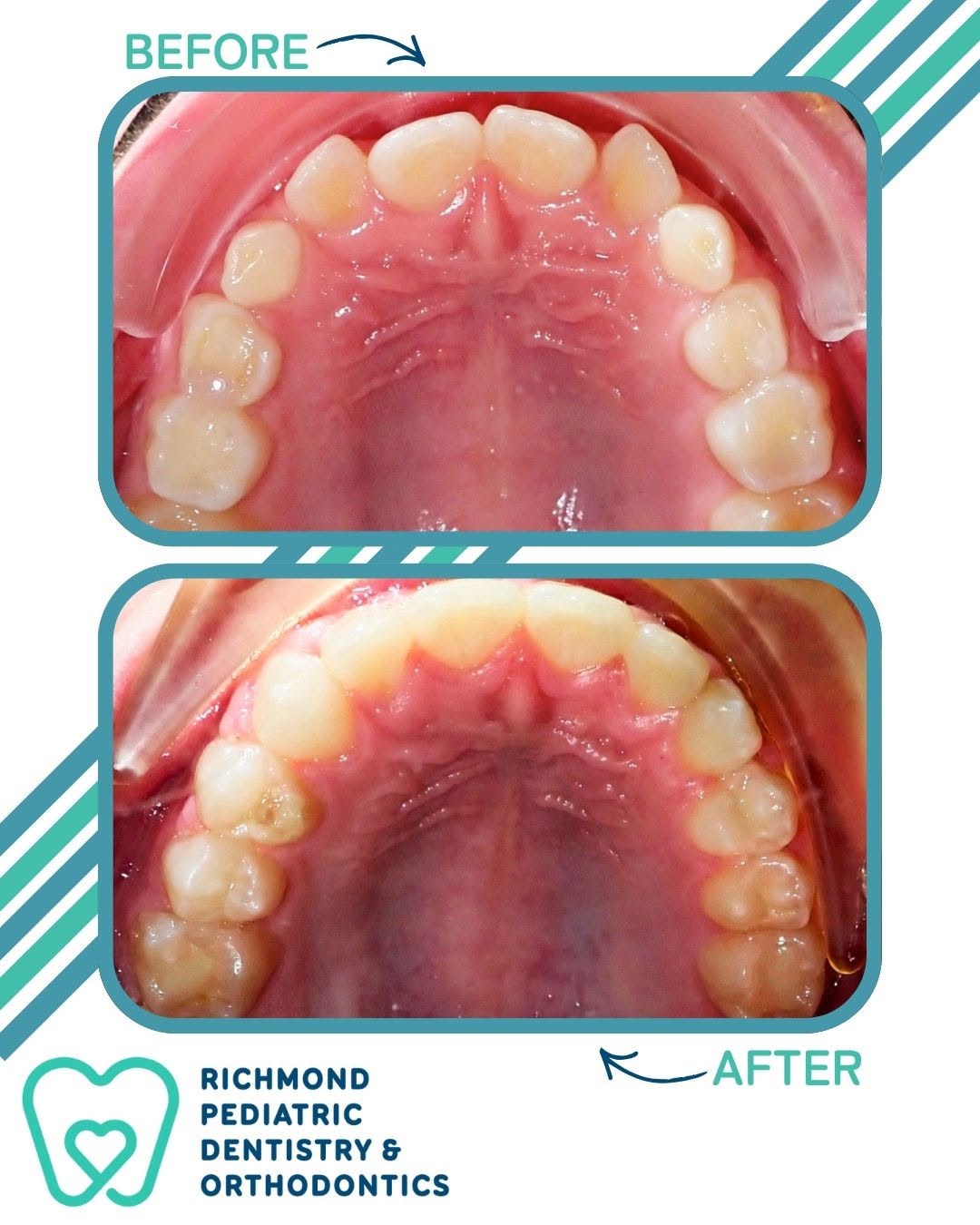 Before and after photos of the upper arch showing a narrow upper jaw widened with a palatal expander