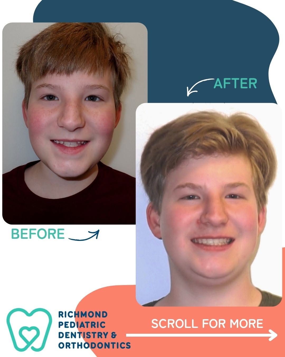 Before and after photos of a teen patient's smile following non-surgical underbite correction at Richmond Pediatric Dentistry and Orthodontics