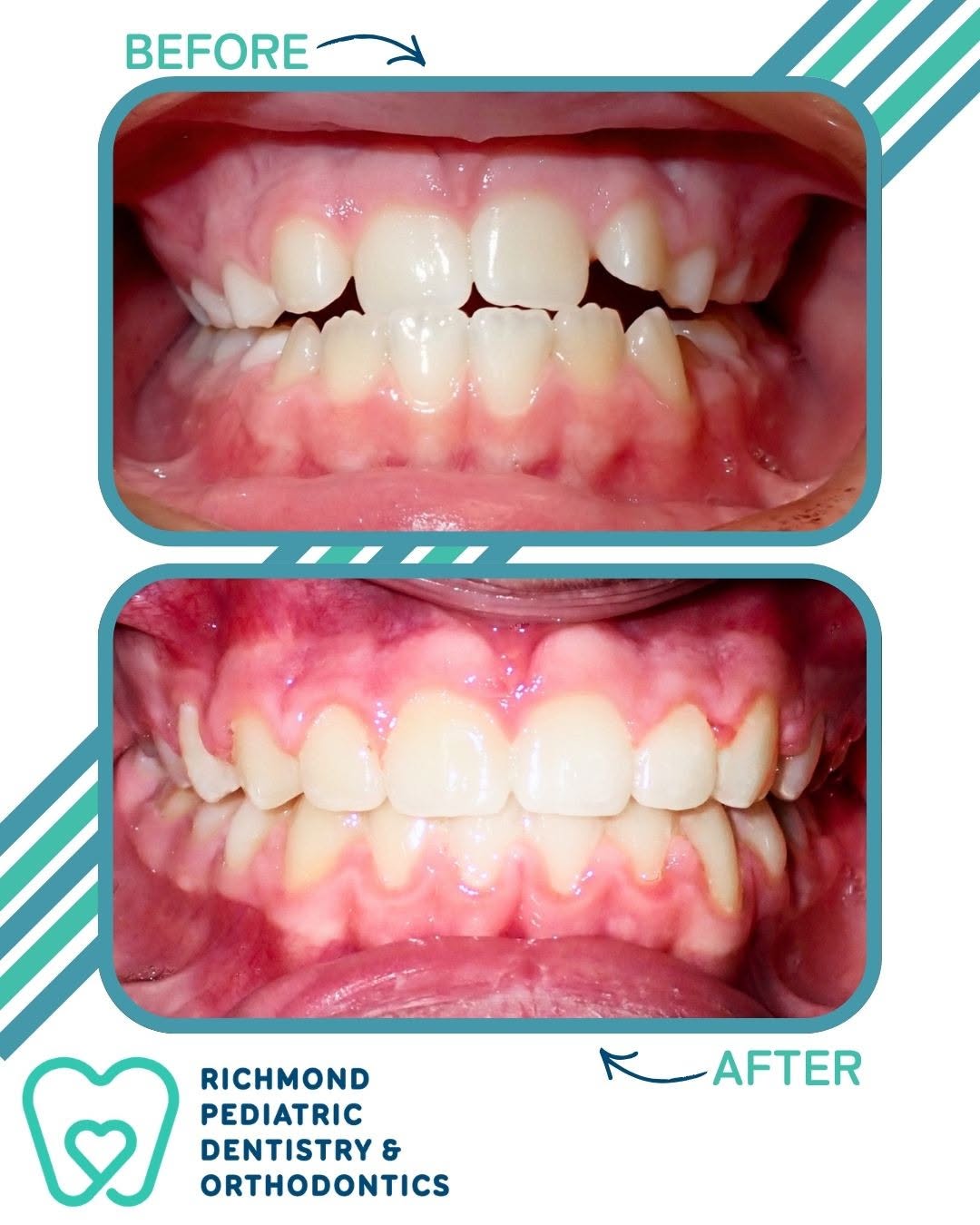 Before and after intraoral photos showing the bite corrected with a rapid palatal expander and braces